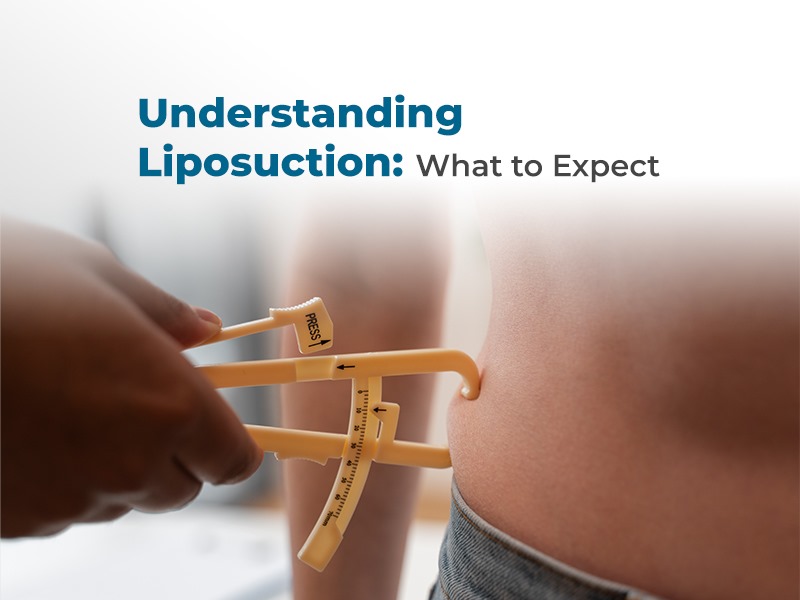 Understanding Liposuction: What to Expect