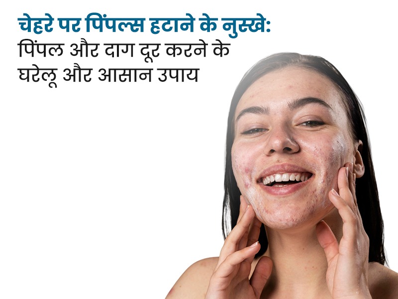 चेहरे पर पिंपल्स हटाने के नुस्खे: घरेलू और आसान उपाय
