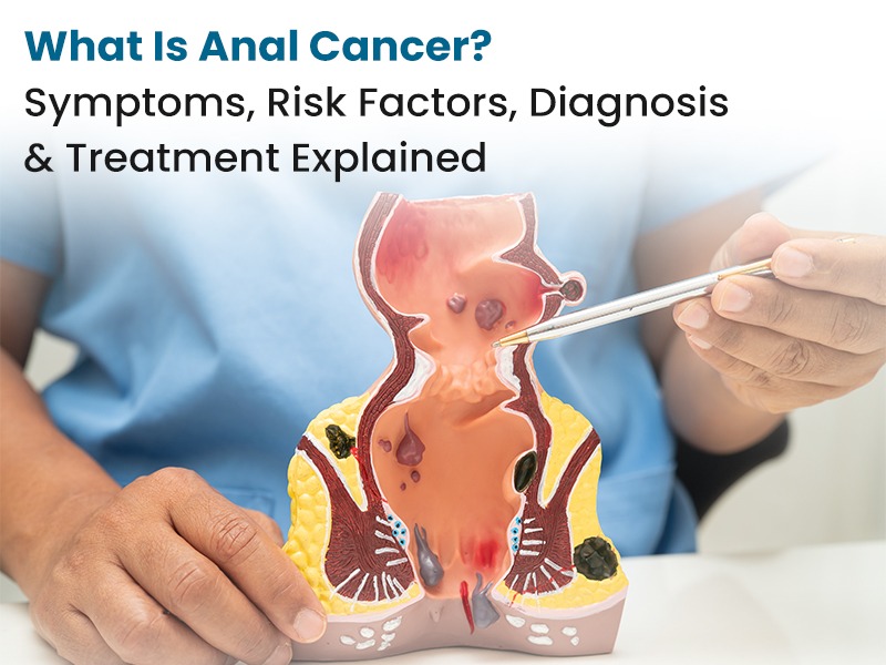 What Is Anal Cancer? Symptoms, Risk Factors, Diagnosis and Treatment Explained