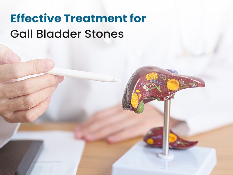 Effective Treatment for Gall Bladder Stones