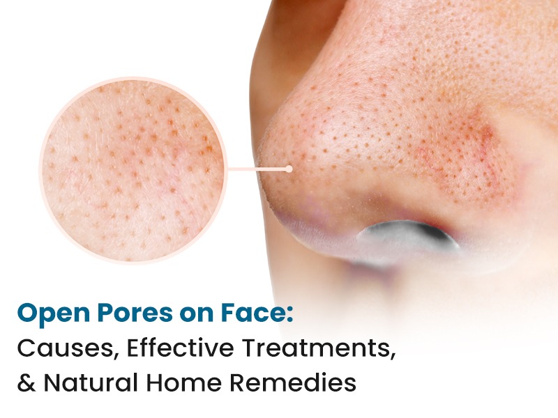 Open Pores on Face: Causes, Effective Treatments, and Natural Home Remedies
