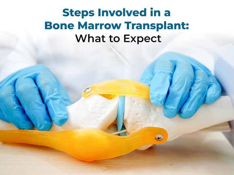 Steps Involved in a Bone Marrow Transplant: What to Expect