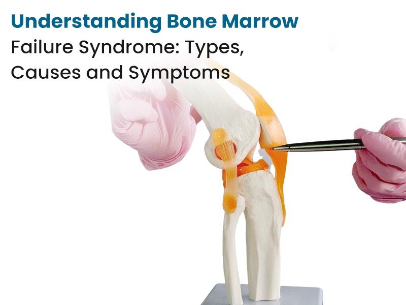 Understanding Bone Marrow Failure Syndrome Types, Causes and Symptoms