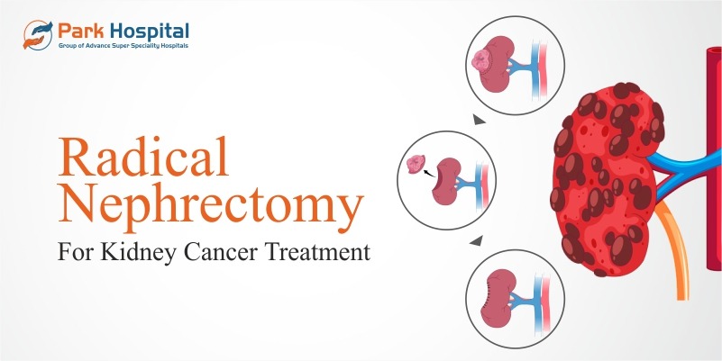 Radical nephrectomy for kidney cancer treatment