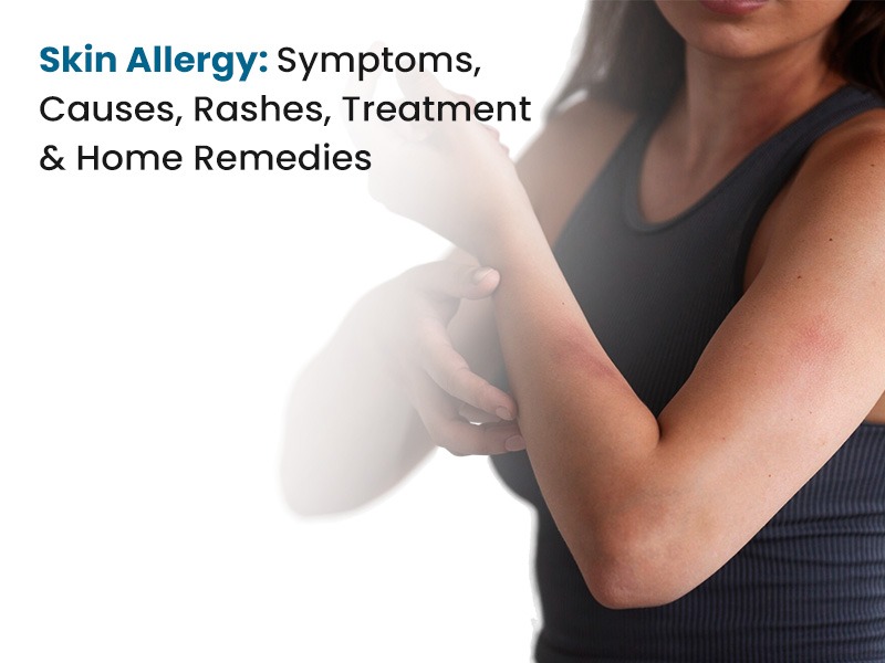 Skin Allergy: Symptoms, Causes, Rashes, Treatment & Home Remedies