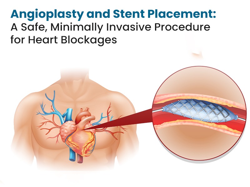 Angioplasty and Stent Placement: A Safe, Minimally Invasive Procedure for Heart Blockages