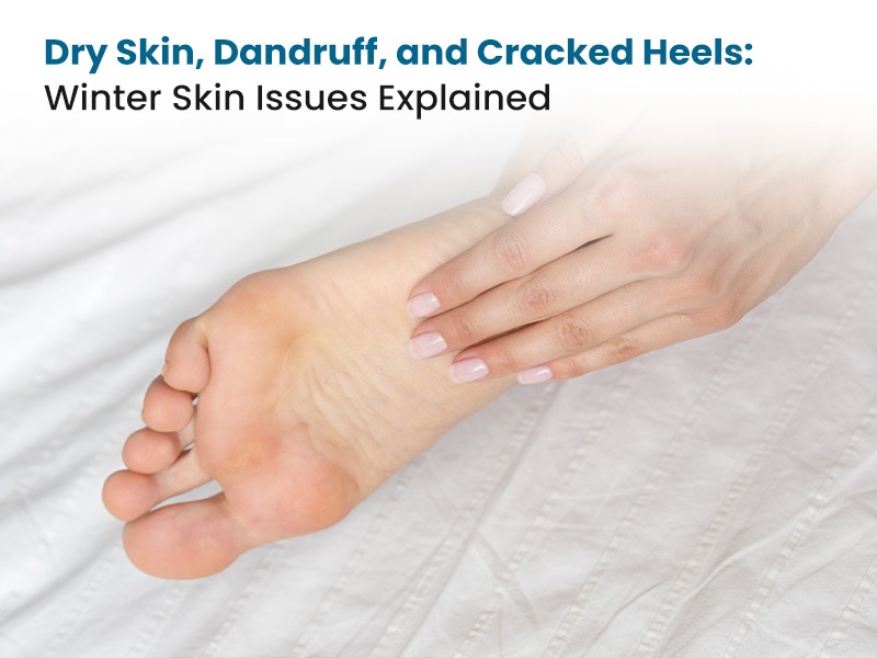 Dry Skin, Dandruff, and Cracked Heels Winter Skin Issues Explained