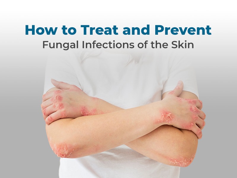 How to Treat and Prevent Fungal Infections of the Skin