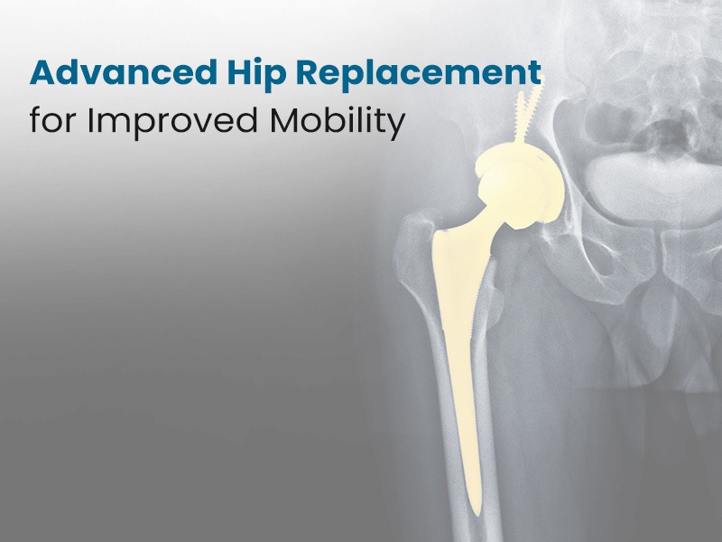 Advanced Hip Replacement for Improved Mobility